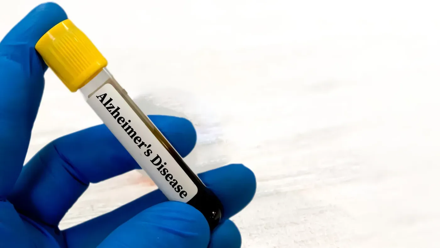 A simple blood test could reveal Alzheimer’s risk 10 years before symptoms