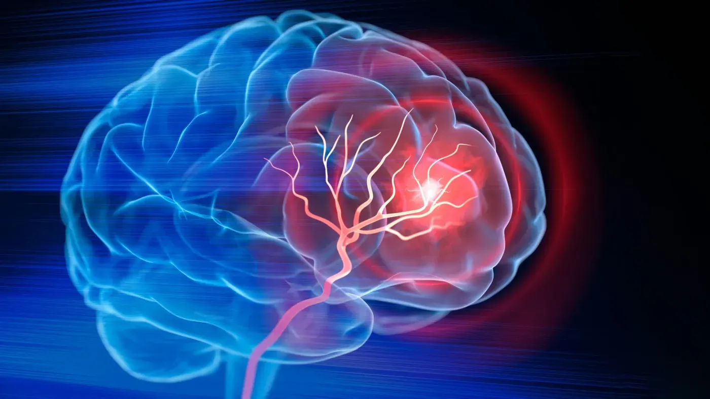 Strokes have nearly doubled among younger adults, and scientists aren't sure why