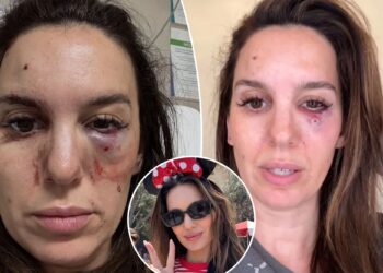 Former Disney Channel star Christy Carlson Romano gives update after being shot in eye