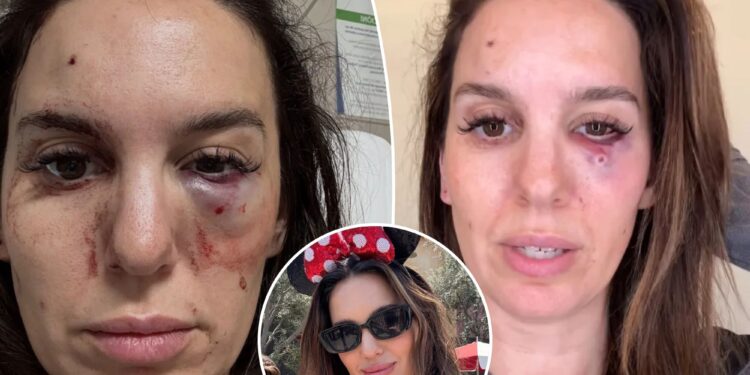 Former Disney Channel star Christy Carlson Romano gives update after being shot in eye