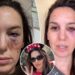 Former Disney Channel star Christy Carlson Romano gives update after being shot in eye