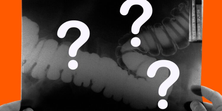 Some doctors got worse at detecting cancer after relying on AI