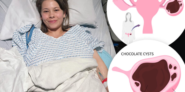 What is a chocolate cyst? Bindi Irwin has growth, lensions removed