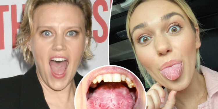 What is 'geographic tongue'? All about 'SNL' star Kate McKinnon's 'gross' condition
