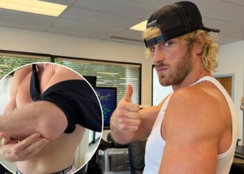 Logan Paul shows off gruesome scar after undergoing arm surgery