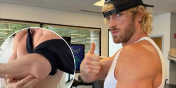 Logan Paul shows off gruesome scar after undergoing arm surgery